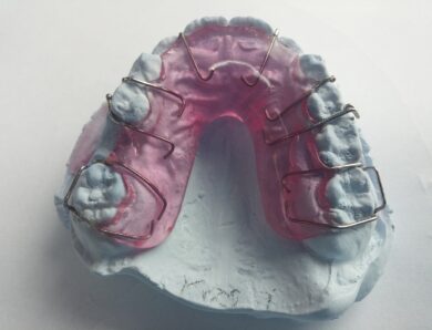 Ile kosztuje aparat ortodontyczny zakładany od wewnątrz?